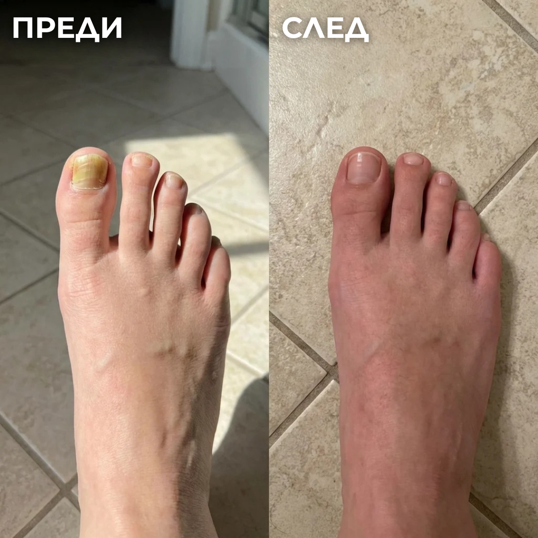 Антигъбична Писалка - 25% Ундециленова Киселина