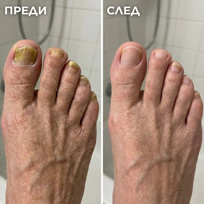 Антигъбична Писалка - 25% Ундециленова Киселина