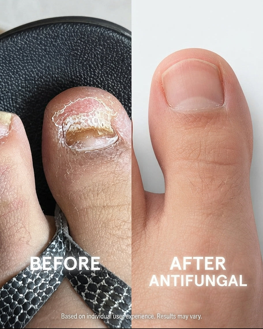 Antifungal Pen - 25% Undecylenic Acid